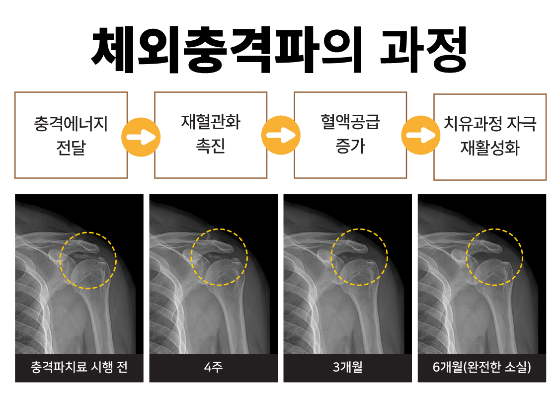 진관동정형외과, 찌르는 듯한 어깨 통증 석회성 건염 (6).jpg