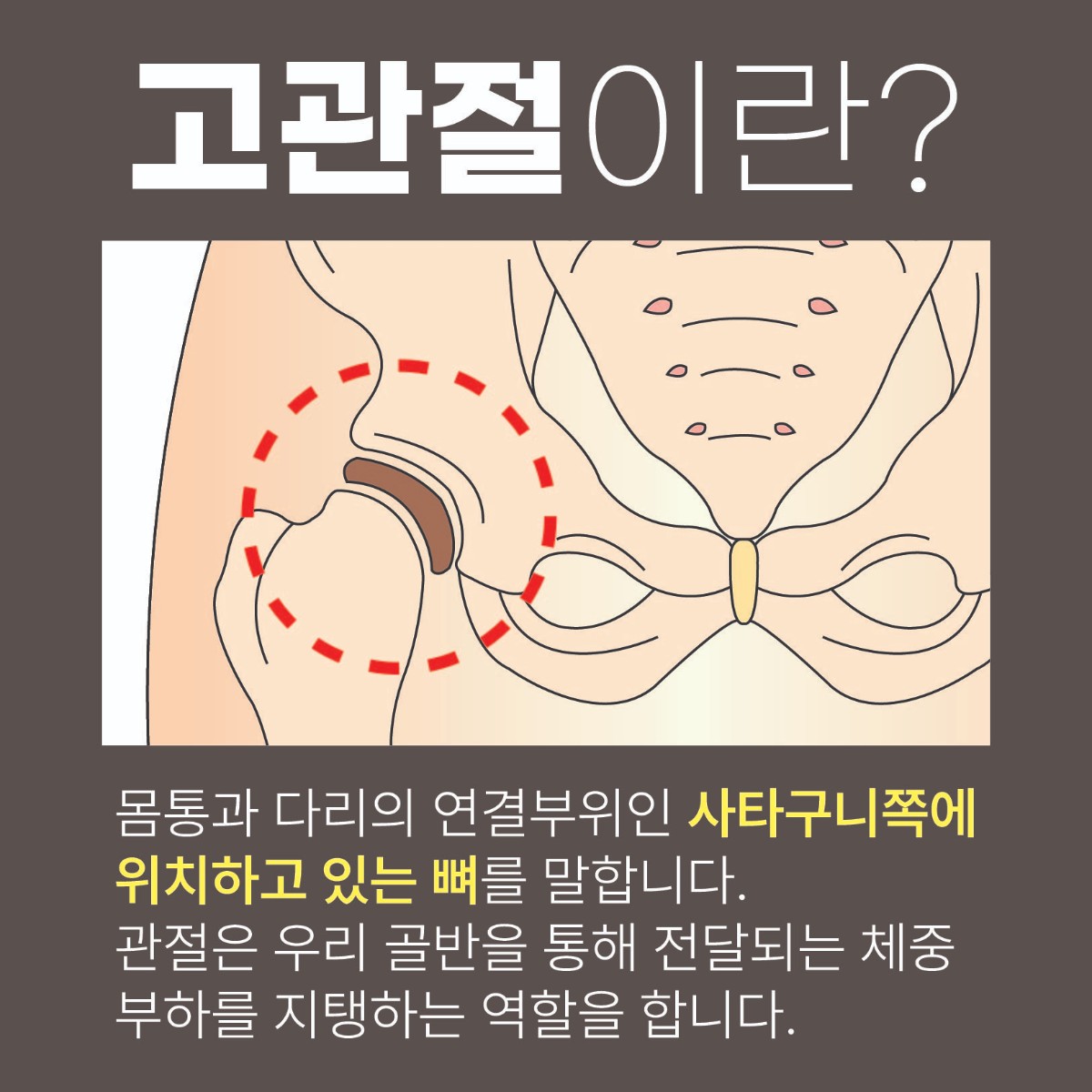 구파발정형외과, 반복되는 고관절 통증, 원인 (4).jpg