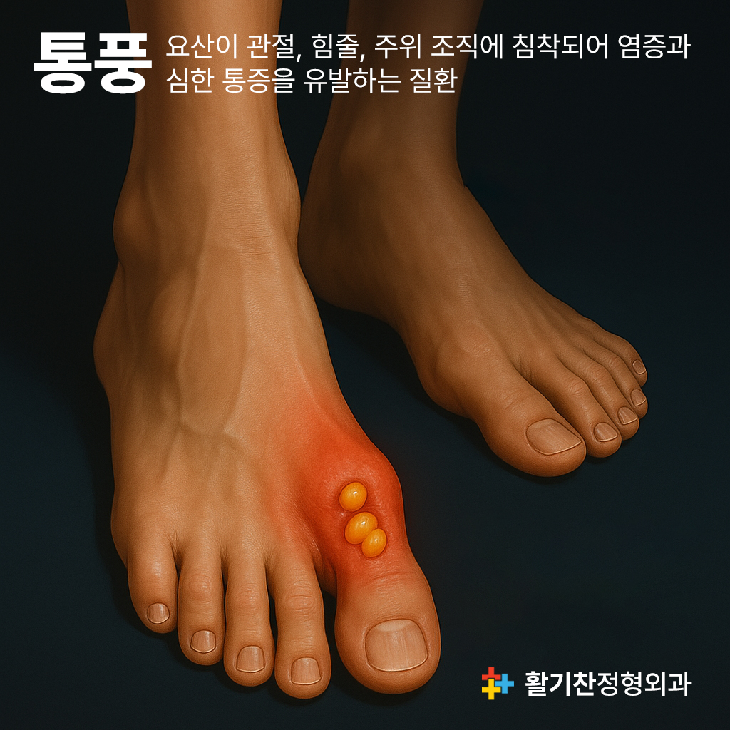 불광동통풍, 4050대 남성 특히 극심한 관절 통증 조심 (4).jpg